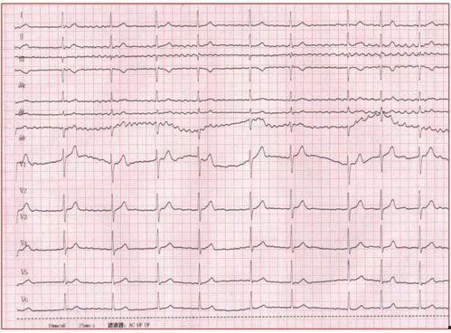 吃瓜网山东心电图事件,揭秘医疗争议背后的真相